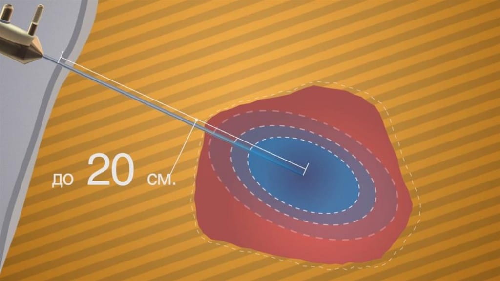 Аргонове зварювання біологічних тканин