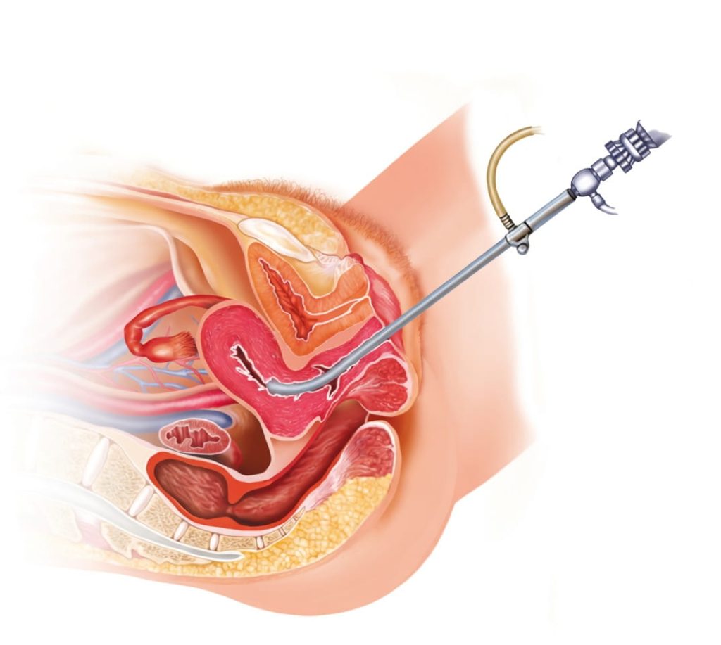 Гістероскопія