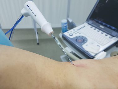 Радіочастотний аблятор