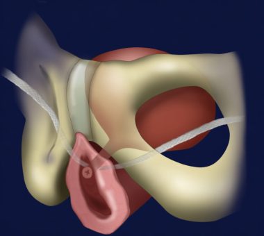 Слінгові операції TVT&nbsp;та&nbsp;TOT